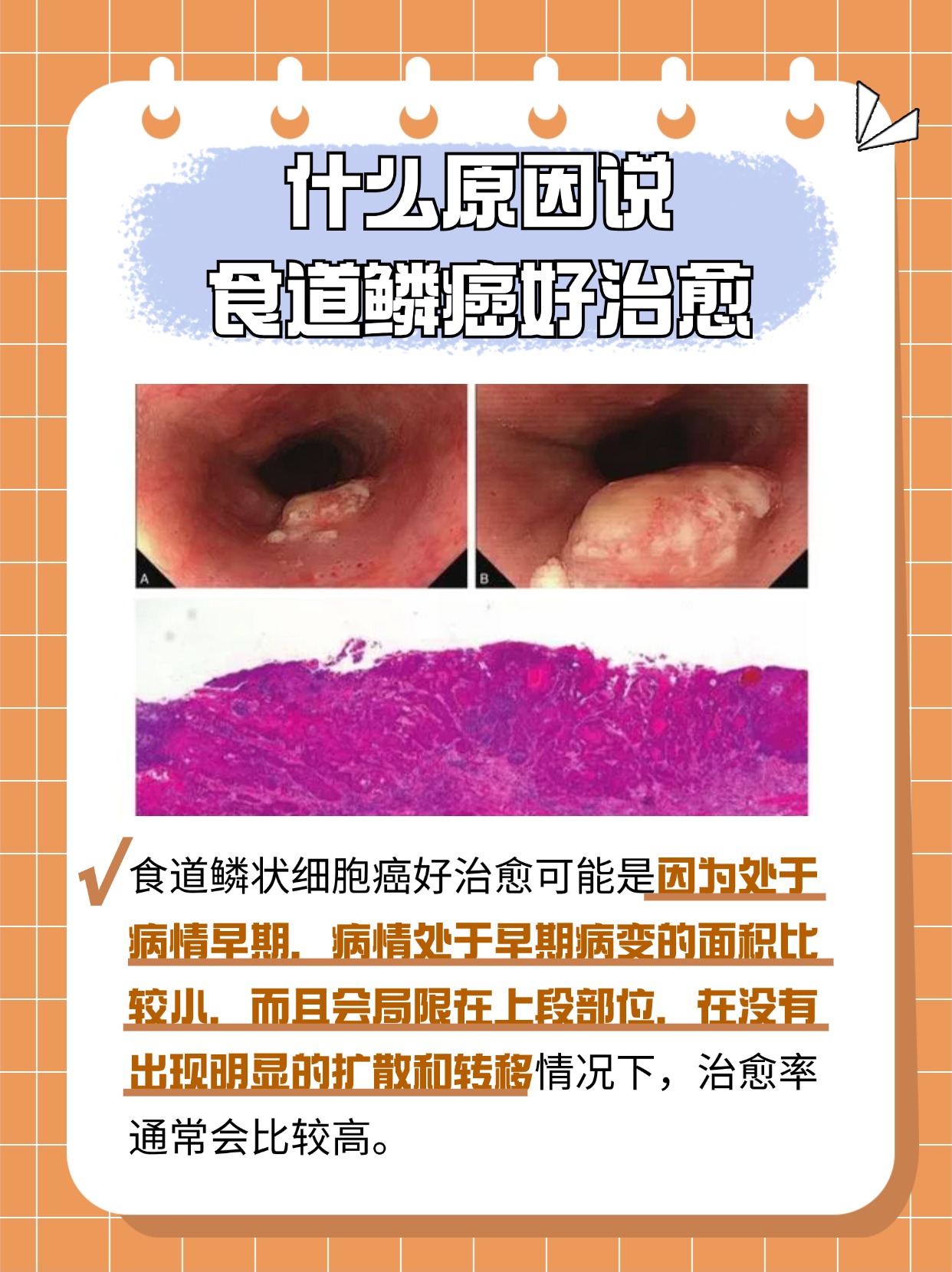 解析--为什么说食道鳞癌好治愈