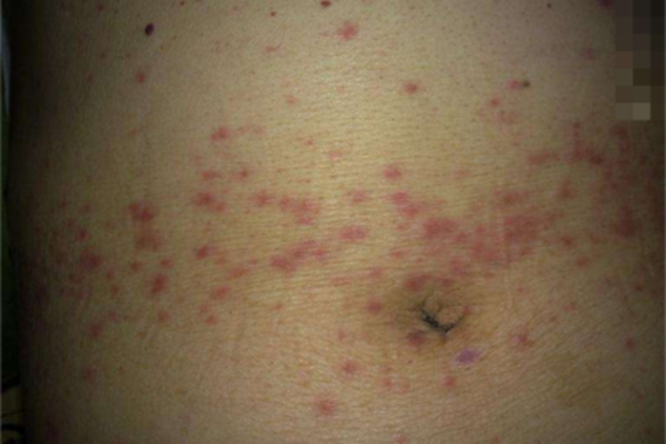 体虱病小红疙瘩图 体虱病小红疙瘩图