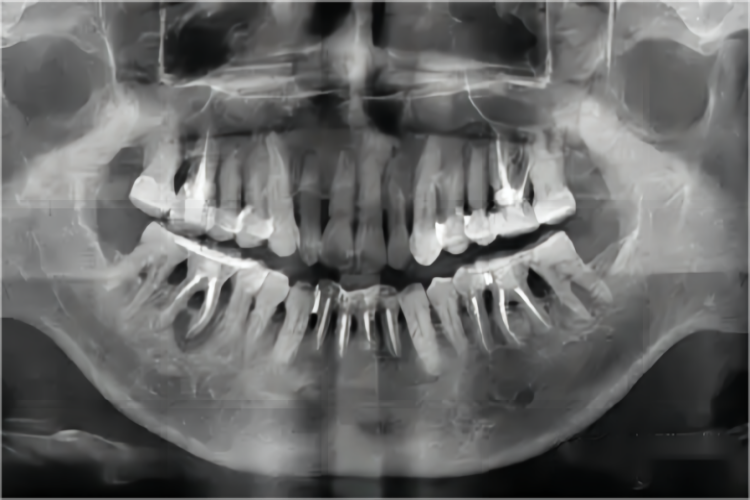 牙槽骨水平型吸收图