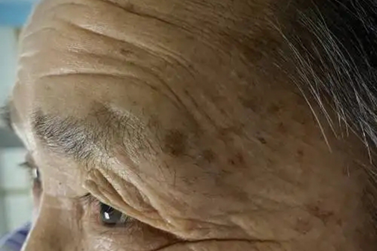 光老化眼周纹图