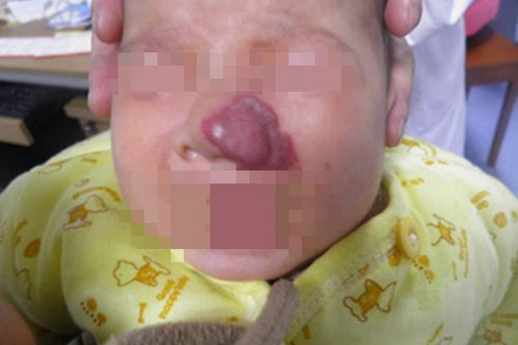 混合型婴儿血管瘤鼻尖症状图