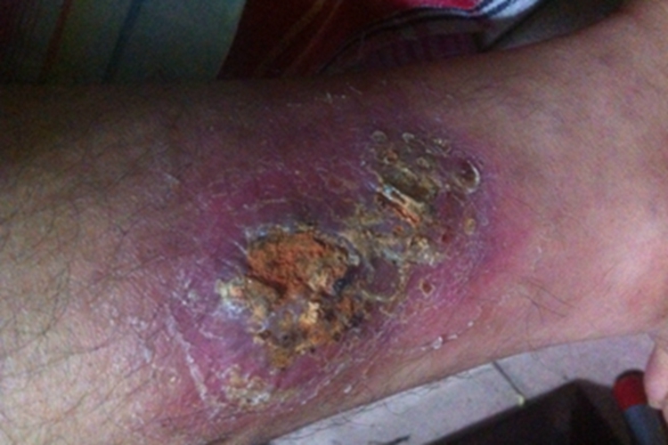 蜂窝织炎小腿发紫图