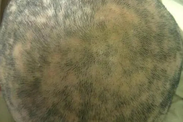 梅毒长在头上图 梅毒长在头上图