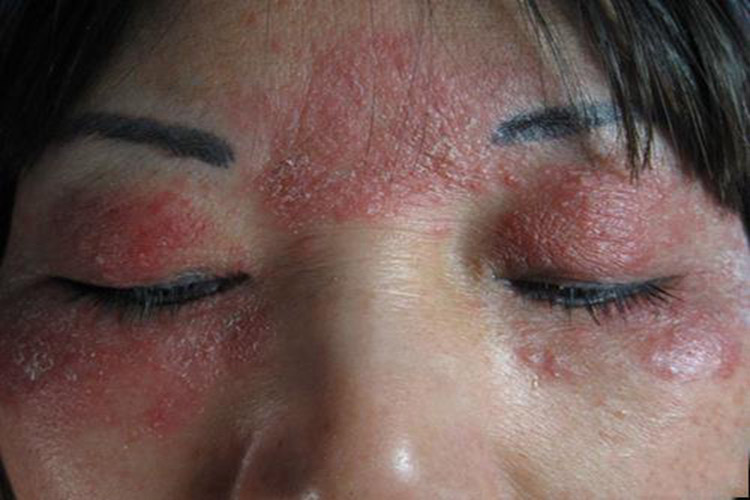 接触性睑皮炎症状图