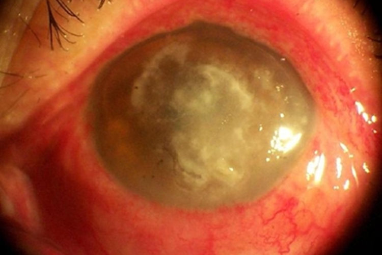 真菌性角膜炎血丝图片 真菌性角膜炎血丝图片