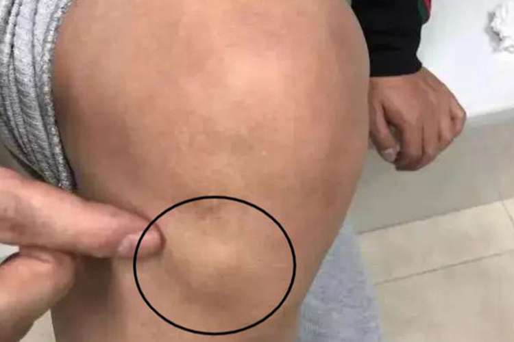 皮肤纤维瘤图 皮肤纤维瘤图