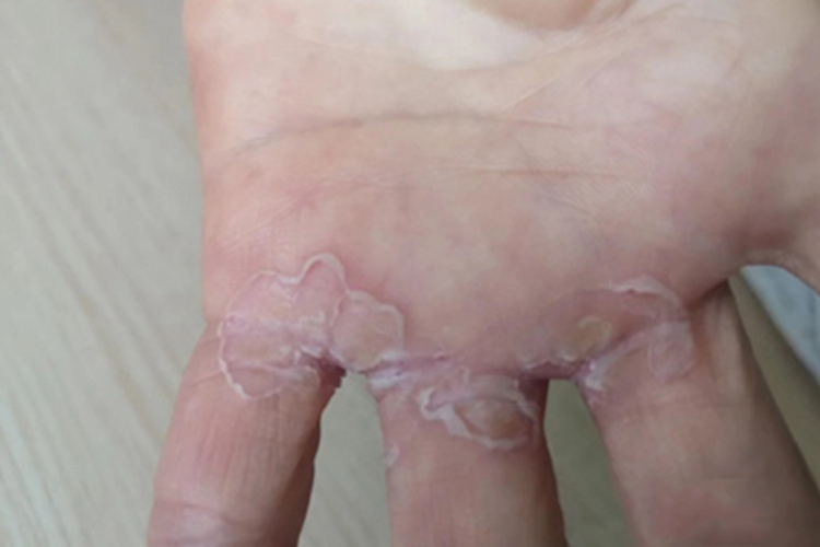 念珠菌性间擦疹手指脱皮图
