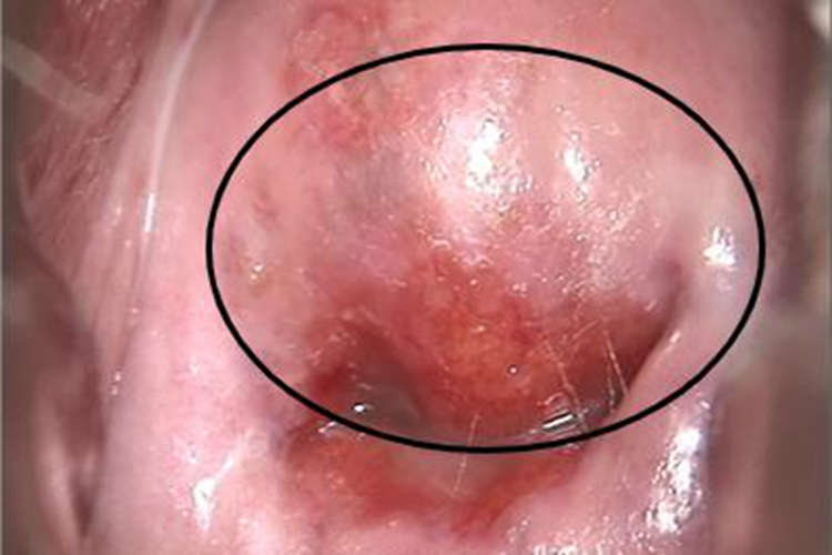 宫颈囊肿阴道包块图