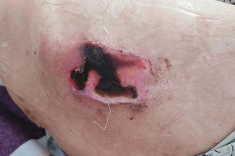 脂质渐进性坏死大腿溃疡图 脂质渐进性坏死大腿溃疡图