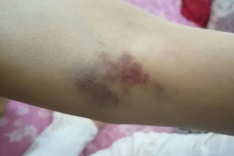 皮下出血图 皮下出血图