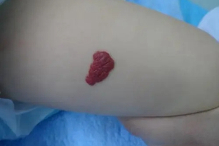 蔓状血管瘤腿部疙瘩图
