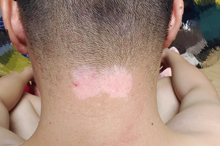 混合型白癜风后颈长斑图