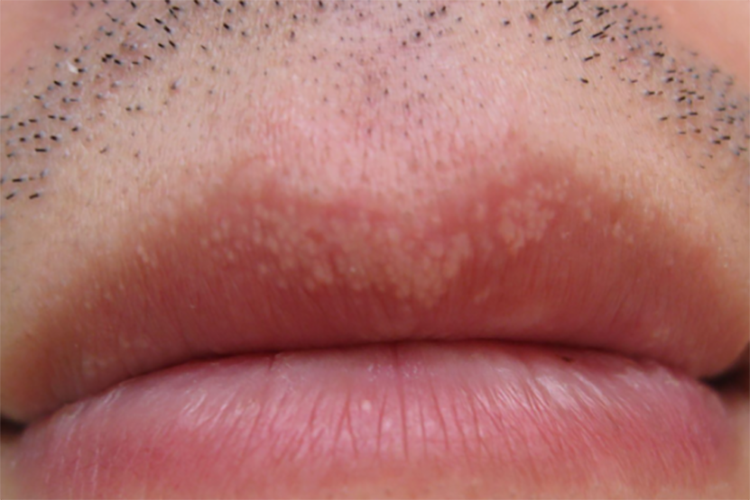 口唇上条索状白色丘疹图