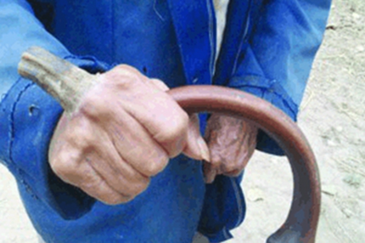 皮角手背上长角样硬块图