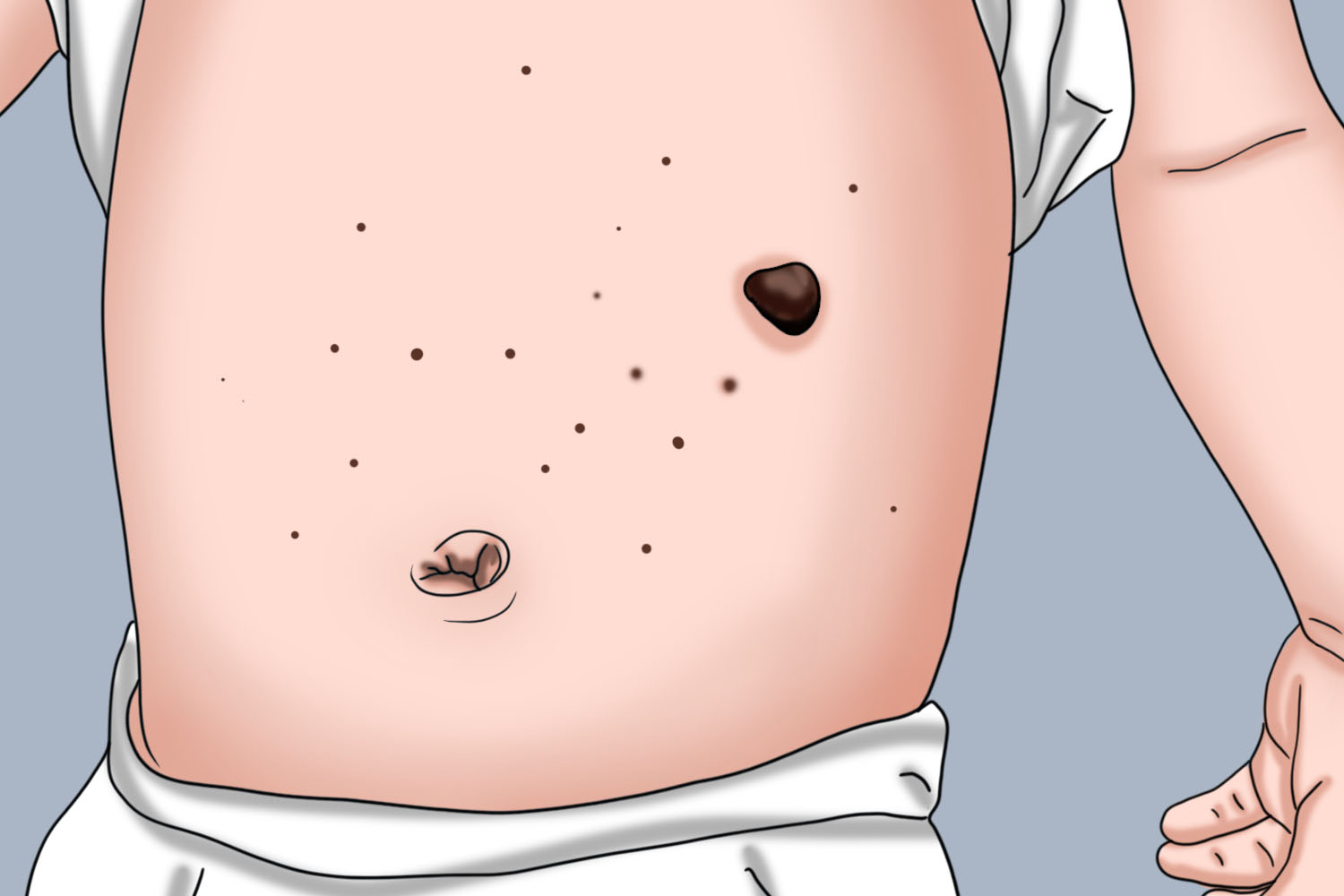 小孩肚皮上脂溢性角化病图 小孩肚皮上脂溢性角化病图