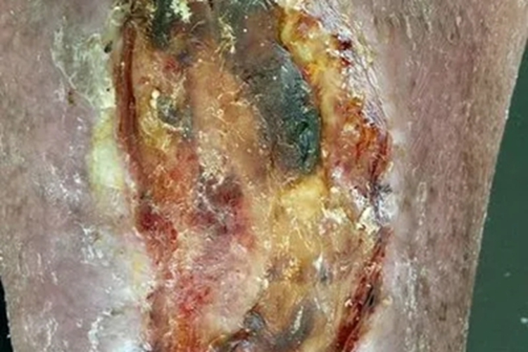 溃疡型坏疽性脓皮病糜烂图