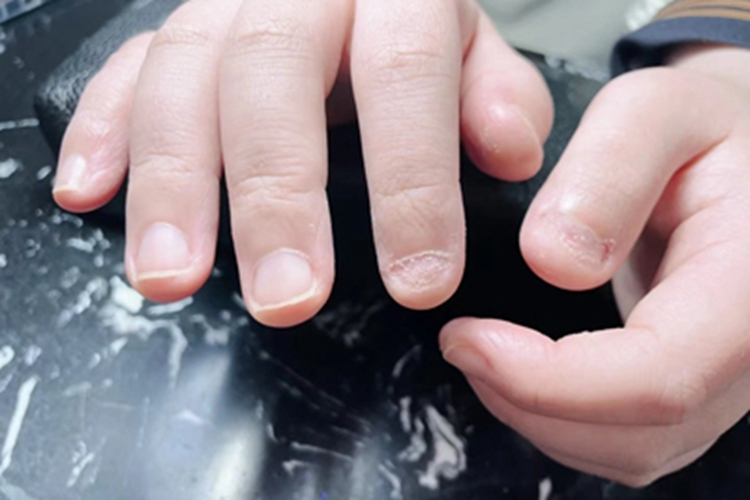 甲萎缩右手食指指甲缺一块图