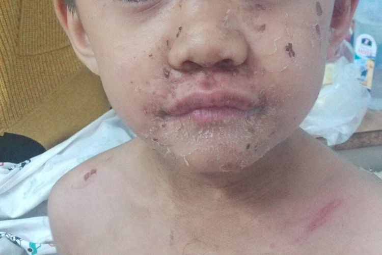 口周放射状裂纹图