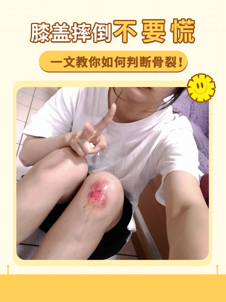 膝盖摔倒不要慌，一文教你如何判断骨裂！