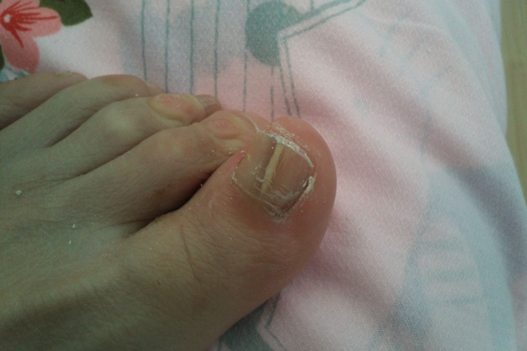 甲纵裂脚趾甲竖纹图