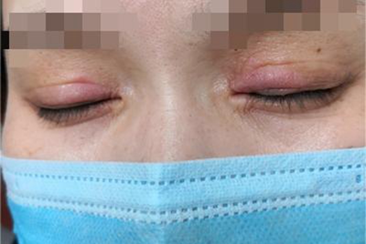 急性眼睑湿疹红肿图