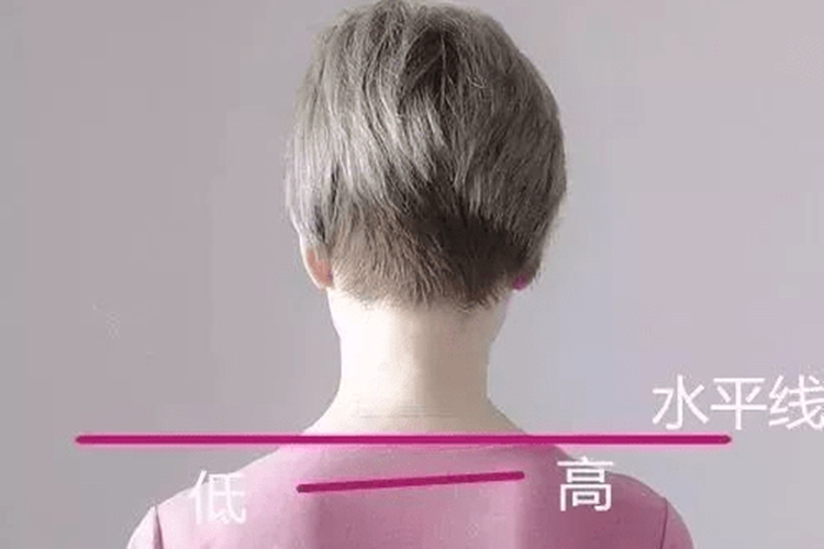 先天性高肩胛症图