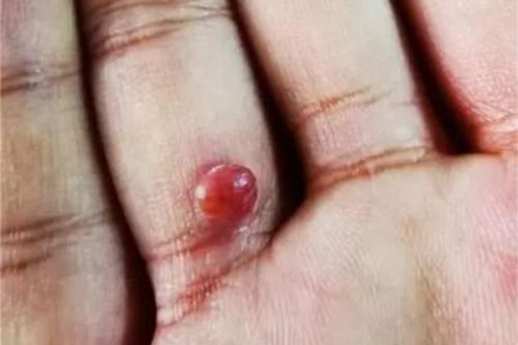 化脓性肉芽肿手指丘疹图