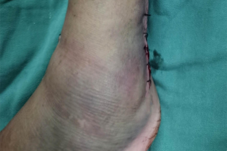 Ⅰ型踝关节骨折脚踝肿大淤青图