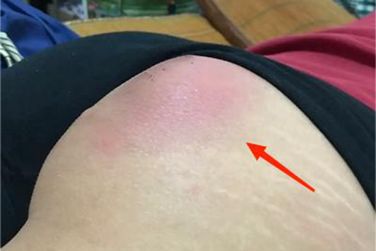 结节性脂膜炎臀部症状图