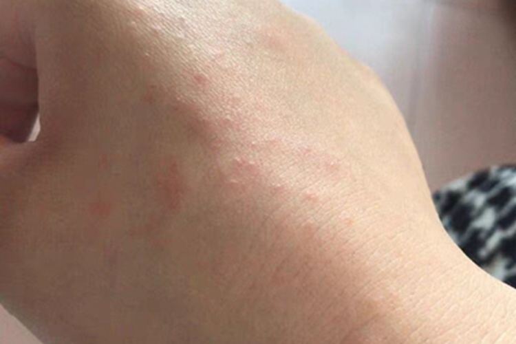 汗疱疹手背起小丘疹图