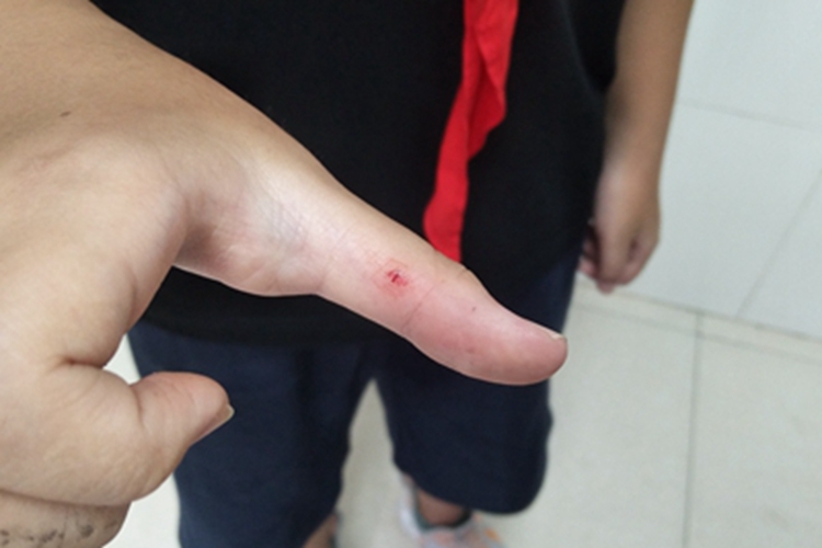 划伤手指症状图