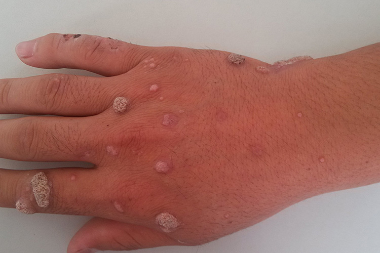寻常疣图 寻常疣图
