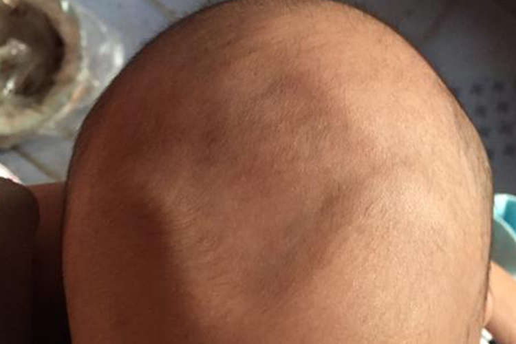 婴儿前囟门明显凹陷图 婴儿前囟门明显凹陷图