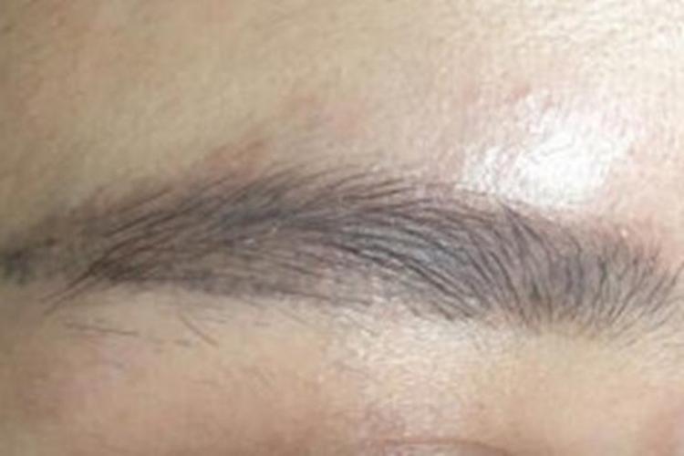 Q激光洗眉效果图