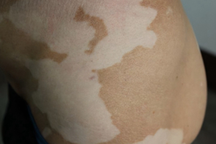 斑状白化病腰部大面积白斑图