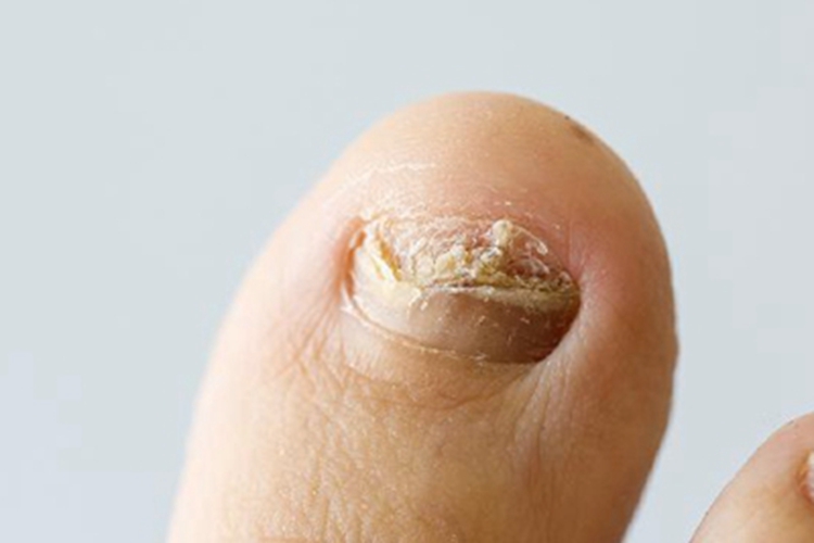 甲床炎脚趾甲脱屑图