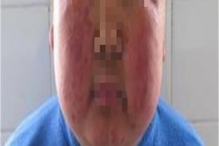 库欣综合征面部症状图