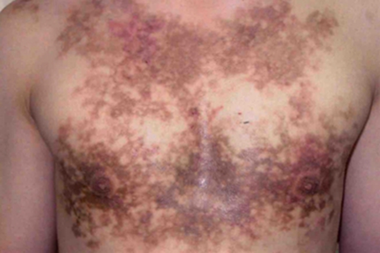 色素性痒疹胸部症状图 色素性痒疹胸部症状图