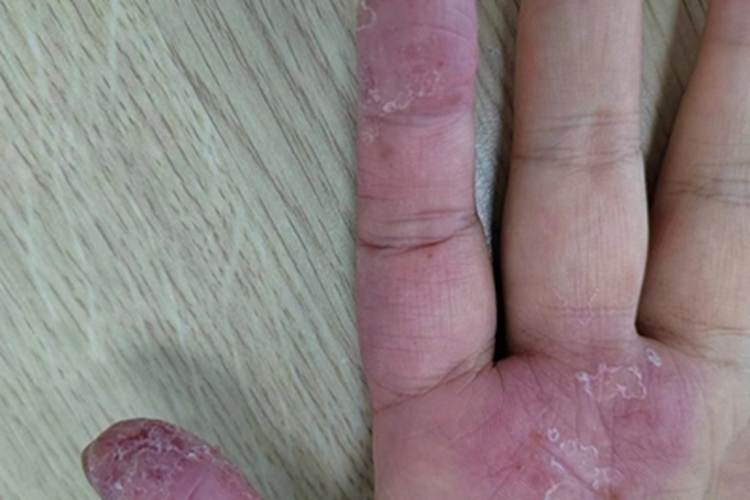 慢性湿疹手掌出现红肿脱屑图