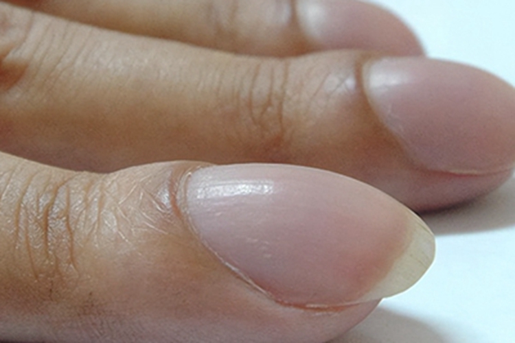 杵状指手指甲症状图