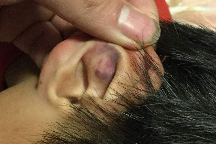 耳朵过敏性紫癜图