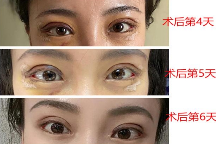 割双眼皮术后4-6天图