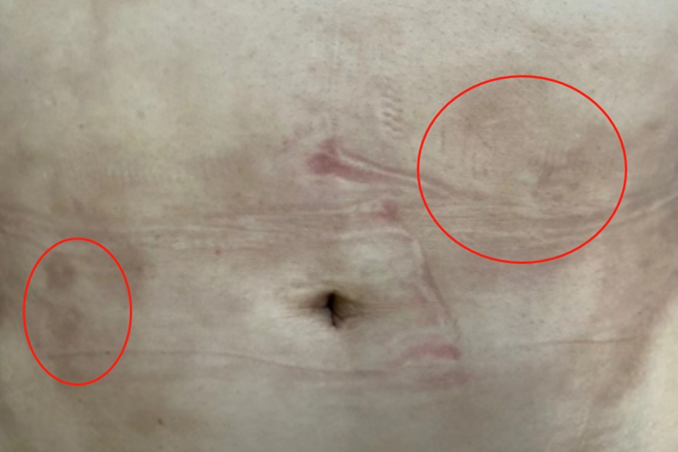 慢性期硬化性脂膜炎腹部硬包图