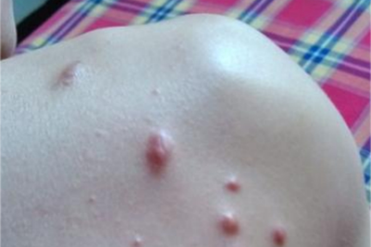 体虱病肩部脓疱图 体虱病肩部脓疱图