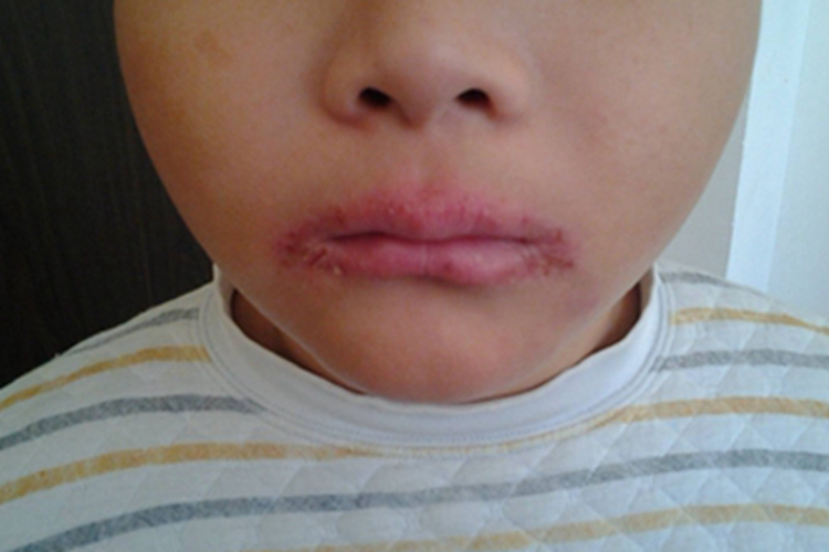 营养不良性口角唇炎嘴唇症状图