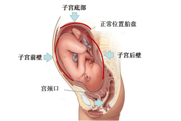 胎盘位于子宫底后壁图