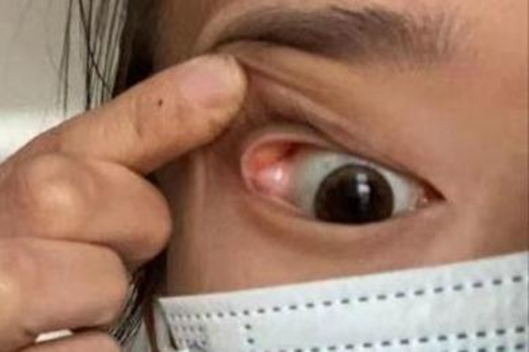 泪腺脱垂严重图片