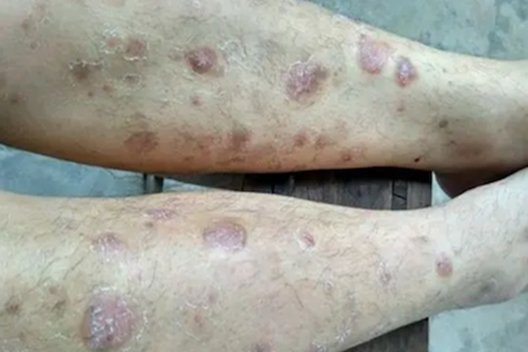 症状性苔藓样疹小腿长斑图 症状性苔藓样疹小腿长斑图