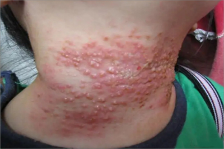 间擦疹前颈小水疱图
