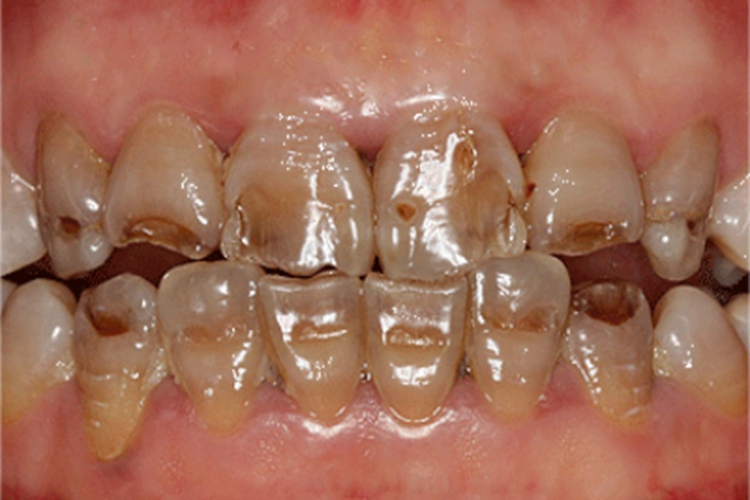 牙齿可有氟斑牙表现,即牙釉质失去色泽变暗,有斑点石灰状